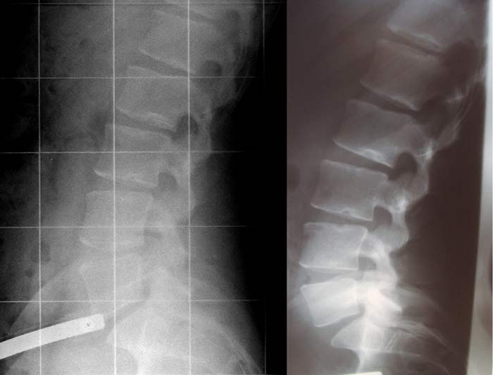 Vergleich LOWDOSE-digital-Aufnahme zu 10 Jahre altem abfotografiertem Röntgenbild