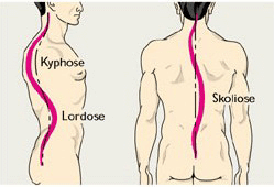 Skoliose &amp; Kyphose/Lordose