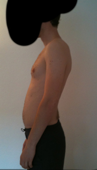 M.Scheuermann + Kyphose