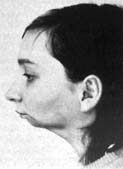 Kieferderformation
