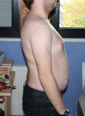 skoliose 2.JPG