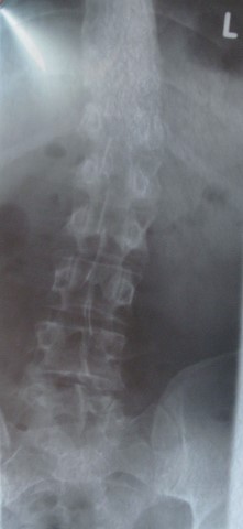 Lendenwirbelsäule 2011