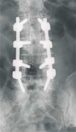 strempel-impl-roe.jpg
